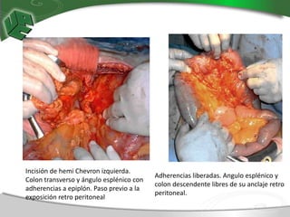 Chevron Invision TÉCNICAS DE INSTRUMENTACIÓN QUIRÚRGICAS EN RIÑÓN PARA ESTUDIANTES DEL ...