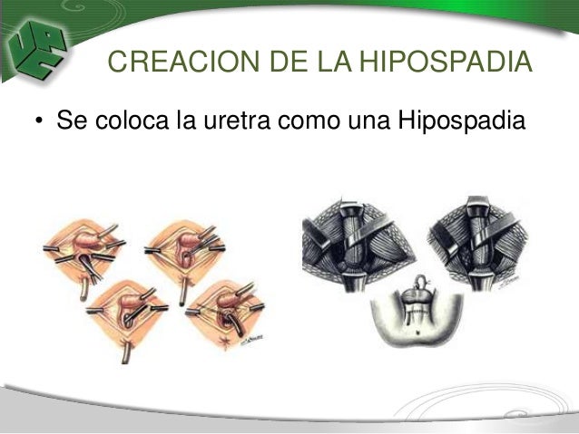 Unidad n° 4 PROCEDIMIENTOS QUIRÚRGICOS EN URETRA