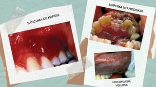 SARCOMA DE KAPOSI
LINFOMA NO HODGKIN
LEUCOPLASIA
VELLOSA
 