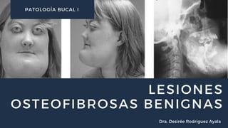 LESIONES
OSTEOFIBROSAS BENIGNAS
PATOLOGÍA BUCAL I
Dra. Desirée Rodríguez Ayala
 