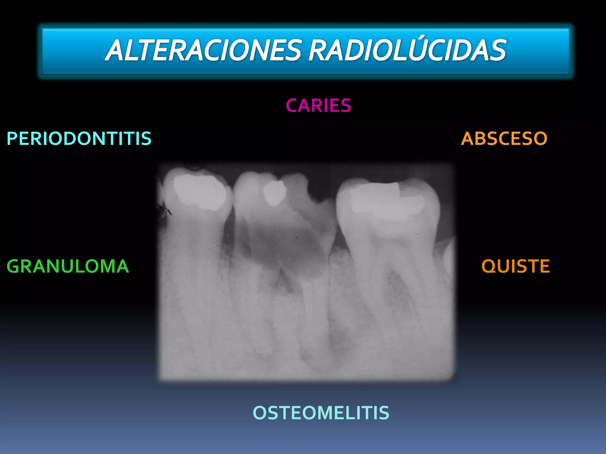 Alteraciones radiolucidas y radiopacas | PPTX