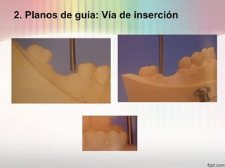 4. Áreas retentivas: Cantidad de
retención de los dientes
 