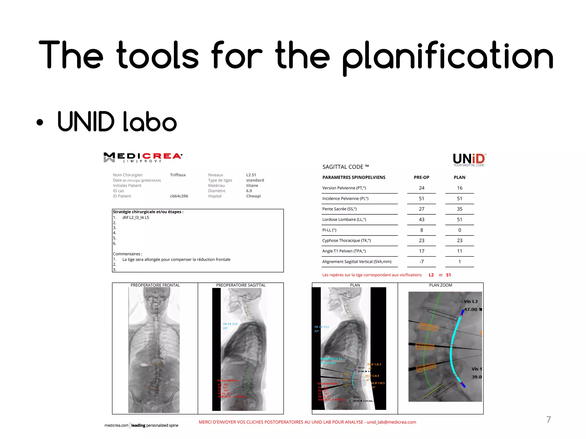 Unid Rods My UNID experience in lumbar arthrodesis for degenerative spine ...