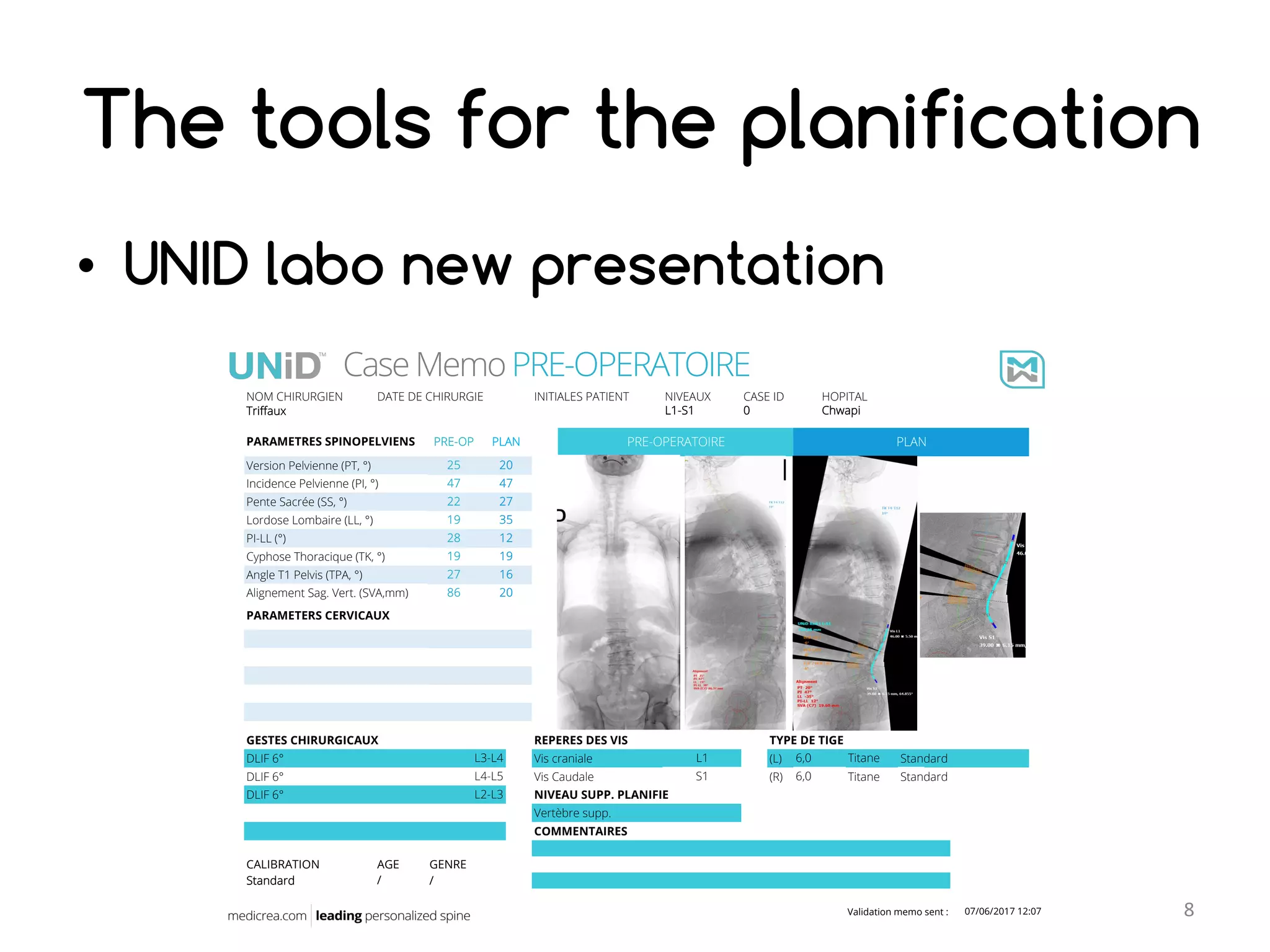Unid Rods My UNID experience in lumbar arthrodesis for degenerative spine ...