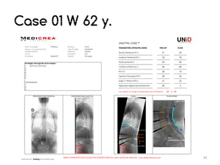 Unid Rods My UNID experience in lumbar arthrodesis for degenerative spine ...