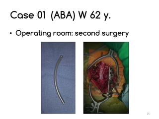Unid Rods My UNID experience in lumbar arthrodesis for degenerative spine ...