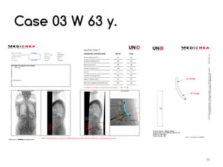 Unid Rods My UNID experience in lumbar arthrodesis for degenerative spine ...