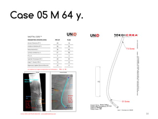 Unid Rods My UNID experience in lumbar arthrodesis for degenerative spine ...