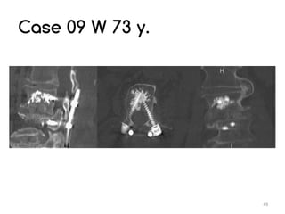 Unid Rods My UNID experience in lumbar arthrodesis for degenerative spine ...