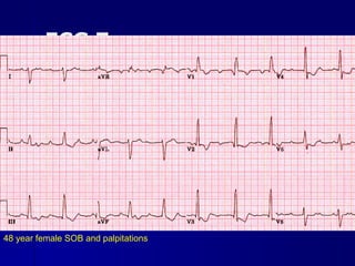 ECG 7 48 year female SOB and palpitations 