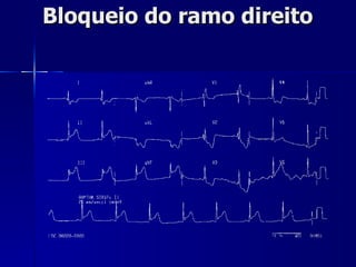 Bloqueio do ramo direito 