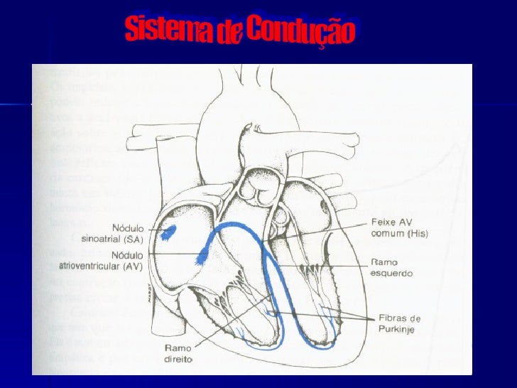 Distúrbio De Condução Do Ramo Direito E Grave