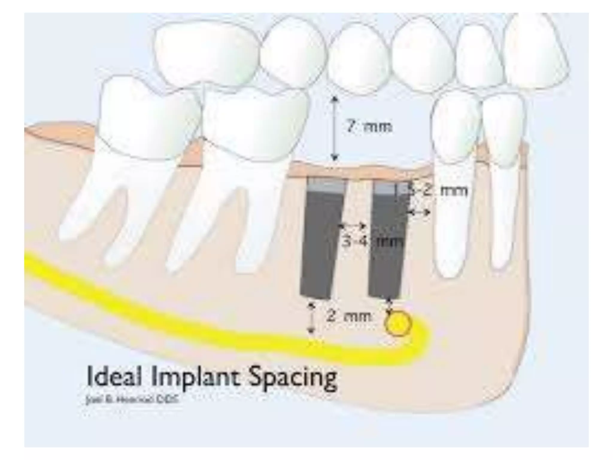 Dental implant principles | PPTX