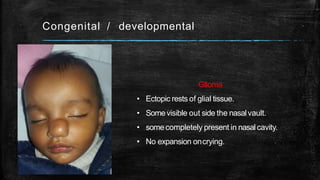 Congenital / developmental
Glioma
• Ectopic rests of glial tissue.
• Somevisible out side the nasalvault.
• somecompletely present in nasalcavity.
• No expansion oncrying.
 
