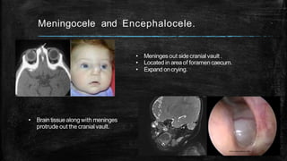 Meningocele and Encephalocele.
• Meningesout sidecranialvault .
• Located in areaof foramencaecum.
• Expand oncrying.
• Brain tissuealong with meninges
protrude out the cranialvault.
 