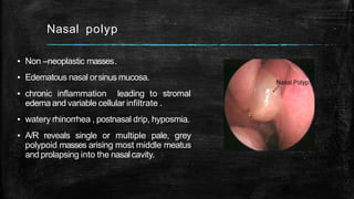 Nasal polyp
▪ Non –neoplastic masses.
▪ Edematous nasal orsinus mucosa.
▪ chronic inflammation leading to stromal
edema and variable cellular infiltrate .
▪ watery rhinorrhea , postnasal drip, hyposmia.
▪ A/R reveals single or multiple pale, grey
polypoid masses arising most middle meatus
and prolapsing into the nasalcavity.
 