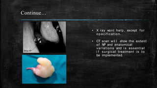Continue…
• X ray wont help, except for
opacification.
• CT scan wil l show the extent
of NP and anatomical
variations and i s essential
i f surgical treatment i s to
be implemented.
 