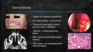 Sarcoidosis
▪ Classicnon caseating granuloma.
▪ Ext. noseandface –lupus pernio
▪ Thickened nasal septum dueto
granulomatous infiltration
▪ Yellowish , nodularappearing
lesion.
▪ DNE: classic sarcoidsubmucosal
nodules.
▪ HPE:classic, non caseatingpattern
asteroid bodies.
 