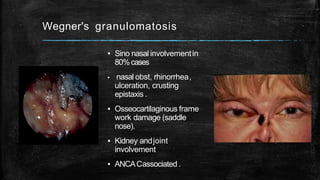 Wegner's granulomatosis
▪ Sino nasal involvementin
80%cases
▪ nasal obst, rhinorrhea,
ulceration, crusting
epistaxis .
▪ Osseocartilaginous frame
work damage (saddle
nose).
▪ Kidney andjoint
involvement
▪ ANCACassociated .
 