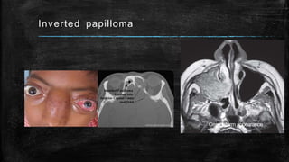 Inverted papilloma
Cerebriform appearance
 