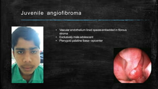 Juvenile angiofibroma
• Vascular endothelium lined spacesembedded in fibrous
stroma
• Exclusively maleadolescent
• Pterygoid palatine fossa–epicenter
 