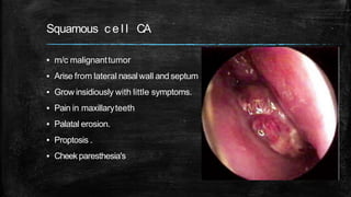 Squamous c e l l CA
▪ m/c malignanttumor
▪ Arise from lateral nasalwall and septum
▪ Grow insidiously with little symptoms.
▪ Pain in maxillaryteeth
▪ Palatal erosion.
▪ Proptosis .
▪ Cheekparesthesia's
 