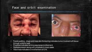Face and o r b i t examination
• Facialswelling , cheek and noseskinthickening indicates tumor involved soft tissue
through anteriorwall.
• Proptosisindicates lamina papyraceainvolvement.
• Diplopiapresent along with proptosis in most cases.
• Visionlossindicates to involvement of O.N.
 