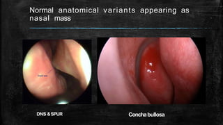 Normal anatomical variants appearing as
nasal mass
ConchabullosaDNS &SPUR
 