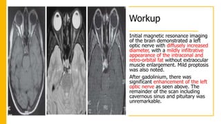 Workup
Initial magnetic resonance imaging
of the brain demonstrated a left
optic nerve with diffusely increased
diameter, with a mildly infiltrative
appearance of the intraconal and
retro-orbital fat without extraocular
muscle enlargement. Mild proptosis
was also noted.
After gadolinium, there was
significant enhancement of the left
optic nerve as seen above. The
remainder of the scan including
cavernous sinus and pituitary was
unremarkable.
 