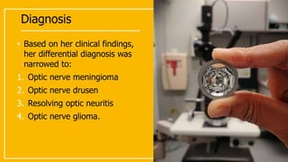Diagnosis
• Based on her clinical findings,
her differential diagnosis was
narrowed to:
1. Optic nerve meningioma
2. Optic nerve drusen
3. Resolving optic neuritis
4. Optic nerve glioma.
 