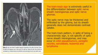 The tram-track sign is extremely useful in
the differentiation between optic nerve
sheath meningiomas and optic nerve
gliomas.
The optic nerve may be thickened and
infiltrated by the glioma, but its sheath
generally does not demonstrate contrast
uptake.
The tram-track pattern, in spite of being a
characteristic sign, is not specific of optic
nerve sheath meningiomas, and may
occur in orbit pseudotumors, perioptic
neuritis, sarcoidosis, leukemia and
lymphoma
 