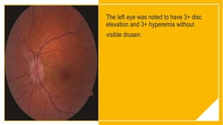 The left eye was noted to have 3+ disc
elevation and 3+ hyperemia without
visible drusen.
 