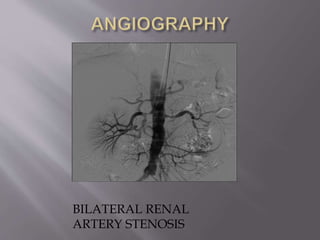 BILATERAL RENAL
ARTERY STENOSIS
 