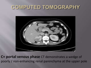 C+ portal venous phase CT demonstrates a wedge of
poorly / non-enhancing renal parenchyma at the upper pole
 