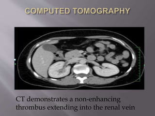 CT demonstrates a non-enhancing
thrombus extending into the renal vein
 
