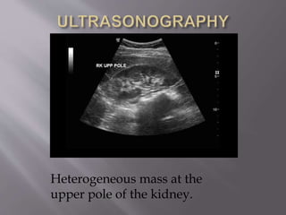 Heterogeneous mass at the
upper pole of the kidney.
 