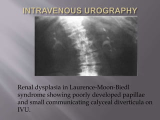 Renal dysplasia in Laurence-Moon-Biedl
syndrome showing poorly developed papillae
and small communicating calyceal diverticula on
IVU.
 