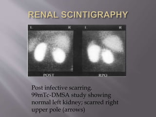 Post infective scarring.
99mTc-DMSA study showing
normal left kidney; scarred right
upper pole (arrows)
 
