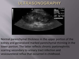 Normal parenchymal thickness in the upper portion of the
kidney and generalized marked parenchymal thinning in the
lower portion. The latter reflects chronic pyelonephritic
scarring secondary to urinary tract infection and
vesicoureteral reflux that occurred in childhood.
 