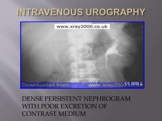 DENSE PERSISTENT NEPHROGRAM
WITH POOR EXCRETION OF
CONTRAST MEDIUM
 