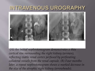 (A) An initial nephrotomogram demonstrates a thin
cortical rim surrounding the right kidney (arrows),
reflecting viable renal cortex perfused by perforating
collateral vessels from the renal capsule. (B) Four months
later, a repeat nephrotomogram shows a marked decrease in
the size of the atrophic right kidney (arrowheads).
 