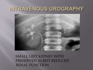 SMALL LEFT KIDNEY WITH
PRESERVED ALBEIT REDUCED
RENAL FUNCTION
 