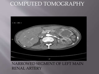 NARROWED SEGMENT OF LEFT MAIN
RENAL ARTERY
COMPUTED TOMOGRAPHY
 
