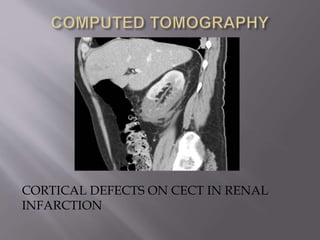 CORTICAL DEFECTS ON CECT IN RENAL
INFARCTION
 