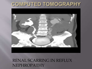 RENAL SCARRING IN REFLUX
NEPHROPATHY
 