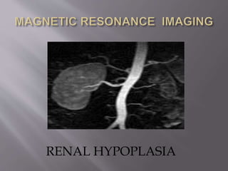 RENAL HYPOPLASIA
 