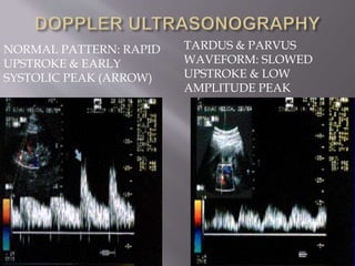 NORMAL PATTERN: RAPID
UPSTROKE & EARLY
SYSTOLIC PEAK (ARROW)
TARDUS & PARVUS
WAVEFORM: SLOWED
UPSTROKE & LOW
AMPLITUDE PEAK
 