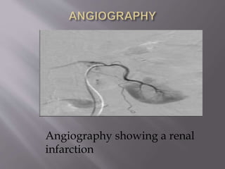 Angiography showing a renal
infarction
 
