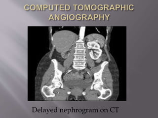 Delayed nephrogram on CT
 