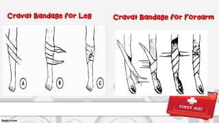 Cravat Bandage for ForearmCravat Bandage for Leg
 